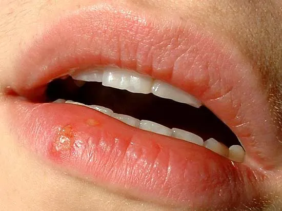 Herpes simplex Virus dolazi u dva oblika: HSV-1 i HSV-2, koji uzrokuje oralni i genitalni herpes. Saznajte više o simptomima, dijagnozi i lečenju ovih virusa.